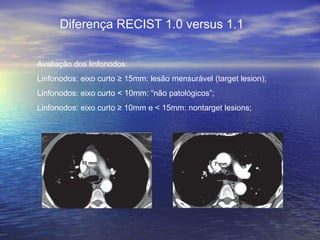 Diferença RECIST 1.0 versus 1.1


Avaliação dos linfonodos:
Linfonodos: eixo curto ≥ 15mm: lesão mensurável (target lesion);
Linfonodos: eixo curto < 10mm: “não patológicos”;
Linfonodos: eixo curto ≥ 10mm e < 15mm: nontarget lesions;
 