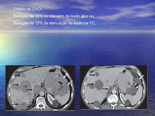 Critério de CHOI:
Redução de 10% no diâmetro da lesão alvo ou;
Redução de 15% da atenuação da lesão na TC.
 
