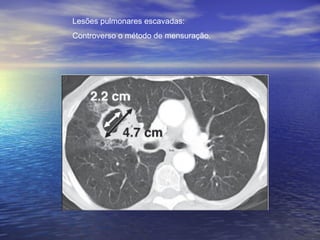 Lesões pulmonares escavadas:
Controverso o método de mensuração.
 