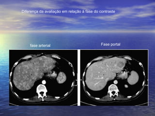 Diferença da avaliação em relação à fase do contraste




    fase arterial                           Fase portal
 