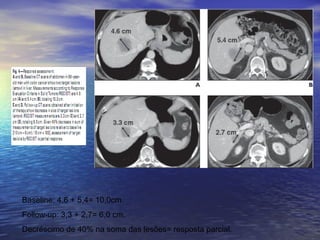 Baseline: 4,6 + 5,4= 10,0cm.
Follow-up: 3,3 + 2,7= 6,0 cm.
Decréscimo de 40% na soma das lesões= resposta parcial.
 