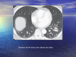 Homem de 64 anos com câncer de cólon
 