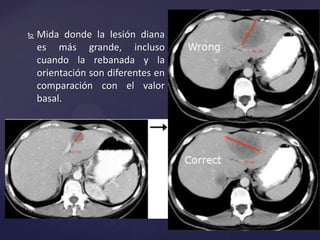  Mida donde la lesión diana
es más grande, incluso
cuando la rebanada y la
orientación son diferentes en
comparación con el valor
basal.
 