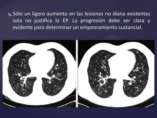  Sólo un ligero aumento en las lesiones no diana existentes
sola no justifica la EP. La progresión debe ser clara y
evidente para determinar un empeoramiento sustancial.
 