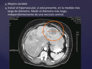  Mejora variable
 Incluir el hipervascular, si está presente, en la medida más
larga de diámetro. Medir el diámetro más largo,
independientemente de una necrosis central.
 