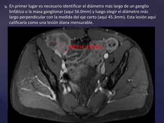  En primer lugar es necesario identificar el diámetro más largo de un ganglio
linfático o la masa ganglionar (aquí 56.0mm) y luego elegir el diámetro más
largo perpendicular con la medida del eje corto (aquí 45.3mm). Esta lesión aquí
calificaría como una lesión diana mensurable.
 
