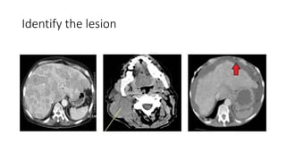 Identify the lesion
 