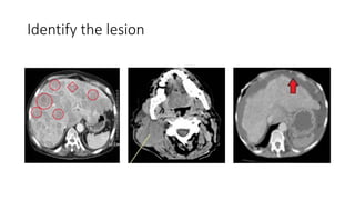 Identify the lesion
 