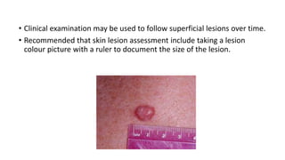 • Clinical examination may be used to follow superficial lesions over time.
• Recommended that skin lesion assessment include taking a lesion
colour picture with a ruler to document the size of the lesion.
 