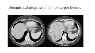 Unequivocal progression of non target lesions
 