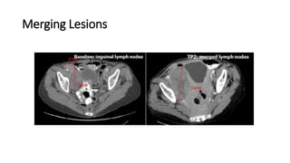 Merging Lesions
 