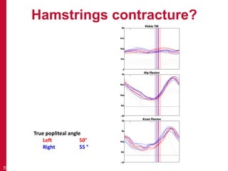 Hamstrings contracture?
18
True popliteal angle
Left 50°
Right 55 °
Pelvic Tilt60
0
Ant
Pst
deg
Hip Flexion70
-20
Flex
Ext
deg
Knee Flexion75
-15
Flx
Ext
deg
 