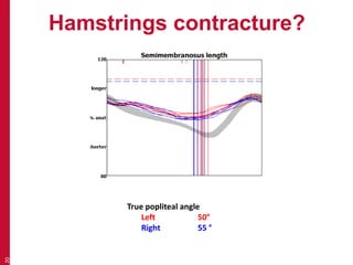 Hamstrings contracture?
20
True popliteal angle
Left 50°
Right 55 °
 