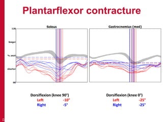 Plantarflexor contracture
23
Dorsiflexion (knee 90°)
Left -10°
Right -5°
Dorsiflexion (knee 0°)
Left -25°
Right -25°
 