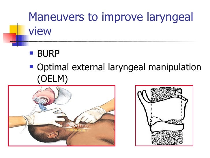 Recognition And Management Of Difficult Airway