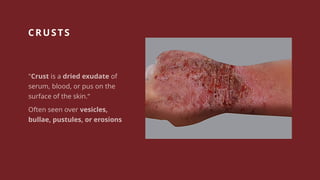 Recognizing Skin Lesions, first step in diagnosis | PPTX