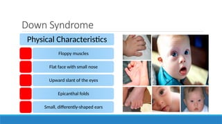Down Syndrome
Physical Characteristics
Floppy muscles
Flat face with small nose
Upward slant of the eyes
Epicanthal folds
Small, differently-shaped ears
 
