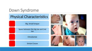 Down Syndrome
Physical Characteristics
Big, broad tongue
Space between the big toe and 2nd
toe
Clinodactyly
Simian Crease
 