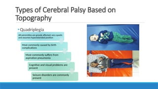 •Quadriplegia
Types of Cerebral Palsy Based on
Topography
All extremities are grossly affected; very spastic
and assumes hyperextended position
Most commonly caused by birth
complications
Most commonly suffers from
aspiration pneumonia
Cognitive and visual problems are
present
Seizure disorders are commonly
present
 
