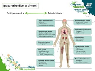 Ipoparatiroidismo: sintomi
Crisi ipocalcemica Tetania latente
 