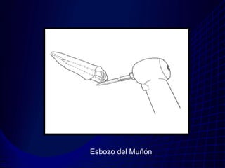 Esbozo del Muñón
 