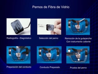 Pernos de Fibra de Vidrio




Radiografía - Diagnóstico       Selección del perno   Remoción de la gutapercha
                                                       Con instrumento caliente




Preparación del conducto        Conducto Preparado        Prueba del perno
 