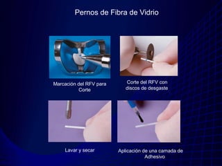 Pernos de Fibra de Vidrio




Marcación del RFV para      Corte del RFV con
          Corte             discos de desgaste




    Lavar y secar        Aplicación de una camada de
                                     Adhesivo
 