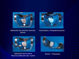 Aplicación de cemento resinoso   Cementado y Fotopolimerización
            léntulo




    Aplicación de la resina             Muñon Preparado
 Para la confección del muñon
 