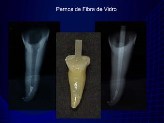 Pernos de Fibra de Vidro
 