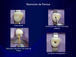 Remoción de Pernos




          Caso inicial
                                       Confección de nicho con fresa
                                                 esférica




Remoción del perno con fresa de
           Peeso
                                         Conducto re-preparado
 