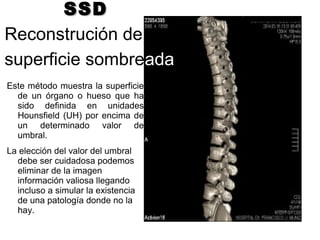 SSDSSD
Reconstrución de
superficie sombreada
Este método muestra la superficie
de un órgano o hueso que ha
sido definida en unidades
Hounsfield (UH) por encima de
un determinado valor de
umbral.
La elección del valor del umbral
debe ser cuidadosa podemos
eliminar de la imagen
información valiosa llegando
incluso a simular la existencia
de una patología donde no la
hay.
 