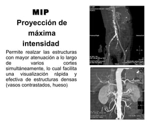 MIPMIP
Proyección de
máxima
intensidad
Permite realzar las estructuras
con mayor atenuación a lo largo
de varios cortes
simultáneamente, lo cual facilita
una visualización rápida y
efectiva de estructuras densas
(vasos contrastados, hueso).
 