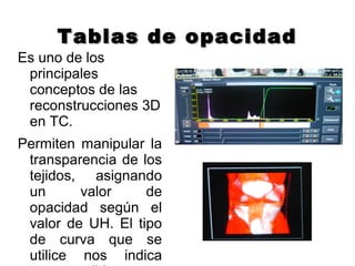 Tablas de opacidadTablas de opacidad
Es uno de los
principales
conceptos de las
reconstrucciones 3D
en TC.
Permiten manipular la
transparencia de los
tejidos, asignando
un valor de
opacidad según el
valor de UH. El tipo
de curva que se
utilice nos indica
 