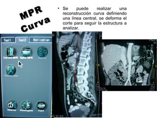 MPR
MPR
Curva
Curva
●
Se puede realizar una
reconstrucción curva definiendo
una línea central, se deforma el
corte para seguir la estructura a
analizar.
 