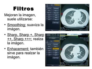 FiltrosFiltros
Mejoran la imagen,
suele utilizarse:
●
Smoothing: suaviza la
imágen.
●
Sharp, Sharp +, Sharp
++, Sharp +++: realza
la imágen.
●
Enhacement: también
sirve para realzar la
imágen.
 
