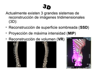 3D3D
Actualmente existen 3 grandes sistemas de
reconstrucción de imágenes tridimensionales
(3D):

Reconstrucción de superficie sombreada (SSDSSD)

Proyección de máxima intensidad (MIPMIP)

Reconstrucción de volumen (VRVR)
 