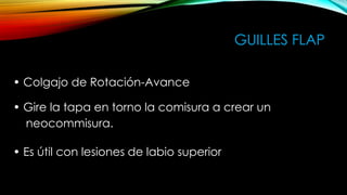 GUILLES FLAP
• Colgajo de Rotación-Avance

• Gire la tapa en torno la comisura a crear un
neocommisura.
• Es útil con lesiones de labio superior

 