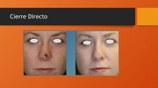 Cierre Directo
 