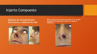 Injerto Compuesto
Defecto de revestimiento,
estructura y cubierta de alar
Raíz compuesta de injerto de hélice a los 10 días
después de la operación, observe el aspecto
isquémico
 