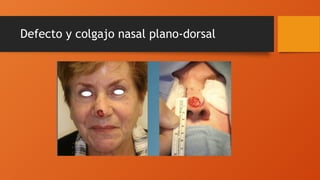 Defecto y colgajo nasal plano-dorsal
 