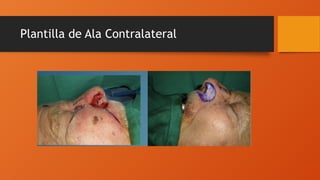 Plantilla de Ala Contralateral
 