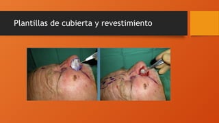 Plantillas de cubierta y revestimiento
 