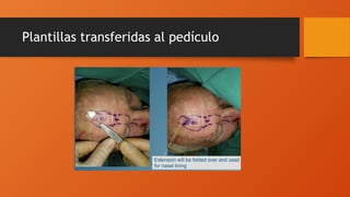 Plantillas transferidas al pedículo
 