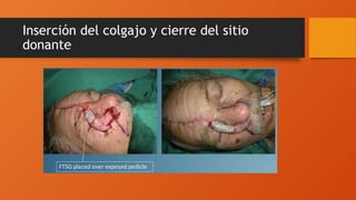 Inserción del colgajo y cierre del sitio
donante
 