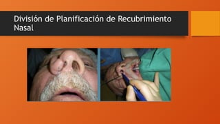 División de Planificación de Recubrimiento
Nasal
 