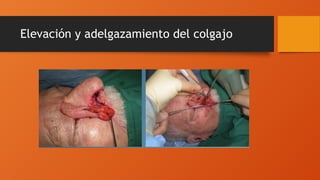 Elevación y adelgazamiento del colgajo
 
