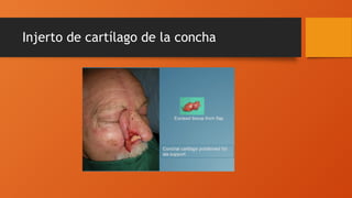 Injerto de cartílago de la concha
 