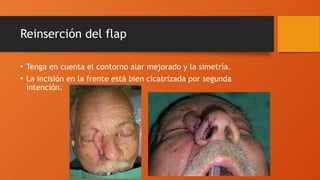 Reinserción del flap
• Tenga en cuenta el contorno alar mejorado y la simetría.
• La incisión en la frente está bien cicatrizada por segunda
intención.
 