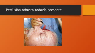 Perfusión robusta todavía presente
 