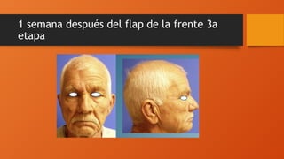 1 semana después del flap de la frente 3a
etapa
 